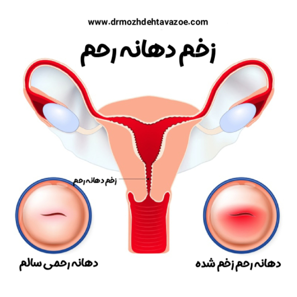 زخم دهانه رحم - دکتر مژده تواضع https://drmozhdehtavazoe.com/