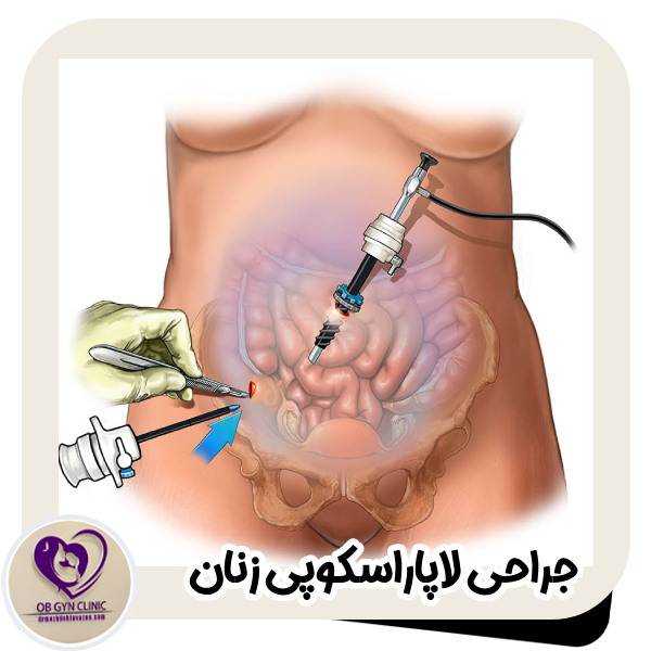 جراحی لاپاراسکوپی زنان - دکتر مژده تواضع https://drmozhdehtavazoe.com/