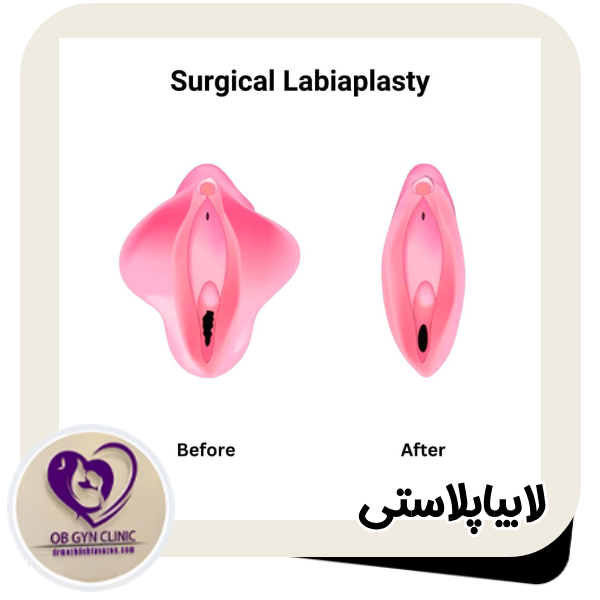 لابیاپلاستی - دکتر مژده تواضع https://drmozhdehtavazoe.com/