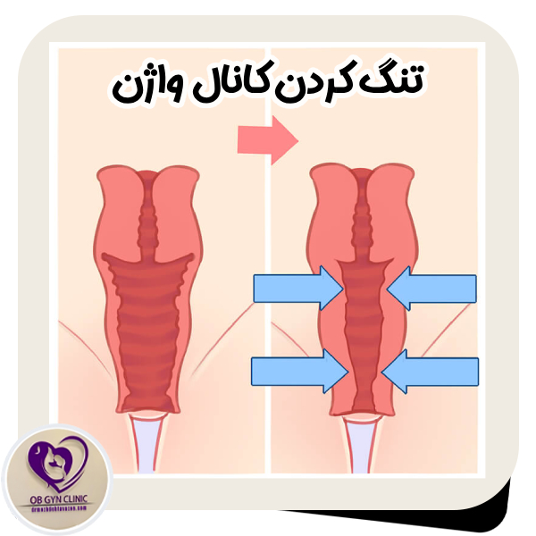تنگ کردن کانال واژن - دکتر مژده تواضع https://drmozhdehtavazoe.com/