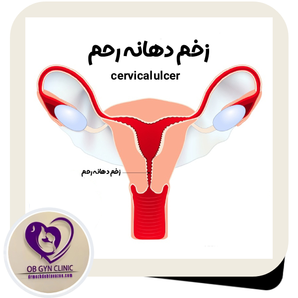 زخم دهانه رحم - دکتر مژده تواضع https://drmozhdehtavazoe.com/