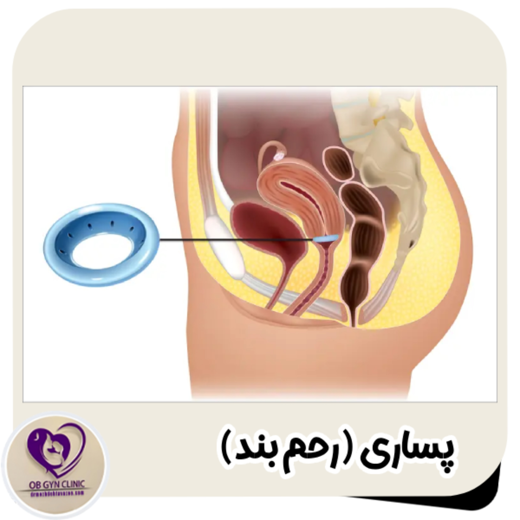 پساری یا رحم بند - دکتر مژده تواضع https://drmozhdehtavazoe.com/