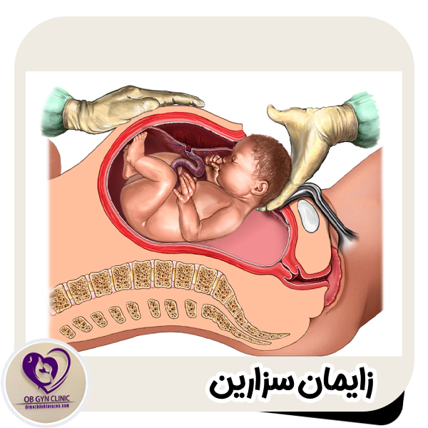زایمان سزارین - دکتر مژده تواضع https://drmozhdehtavazoe.com/