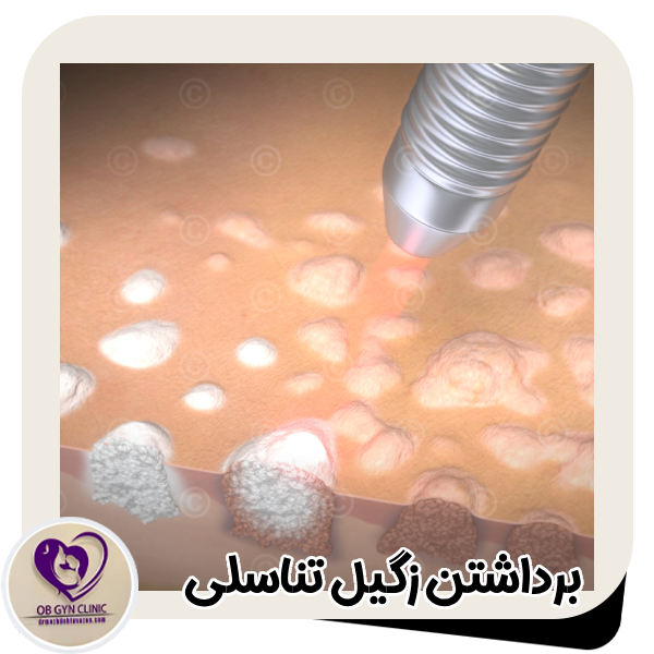 برداشتن زگیل تناسلی - دکتر مژده تواضع https://drmozhdehtavazoe.com/