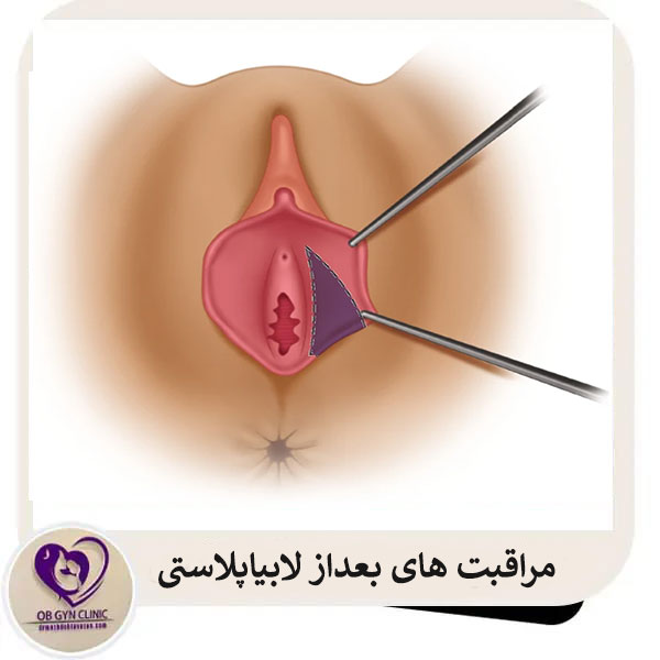 مراقبت های بعد از لابیاپلاستی _ دکتر مژده تواضع