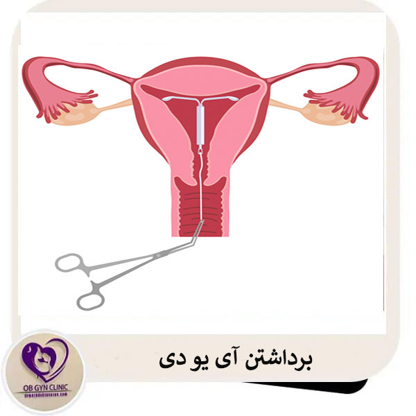 برداشتن آی یو دی _ دکتر مژده تواضع