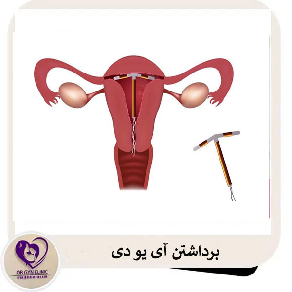 برداشتن آی یو دی _ دکتر مژده تواضع