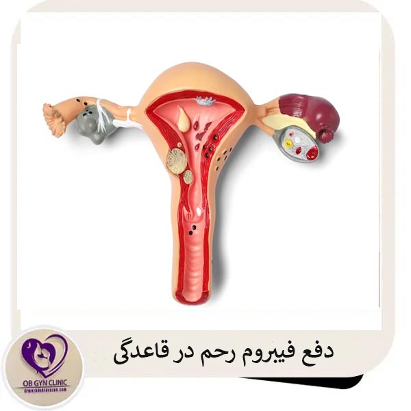 دفع فیبرومرحم در قاعدگی _ دکتر مژده تواضع