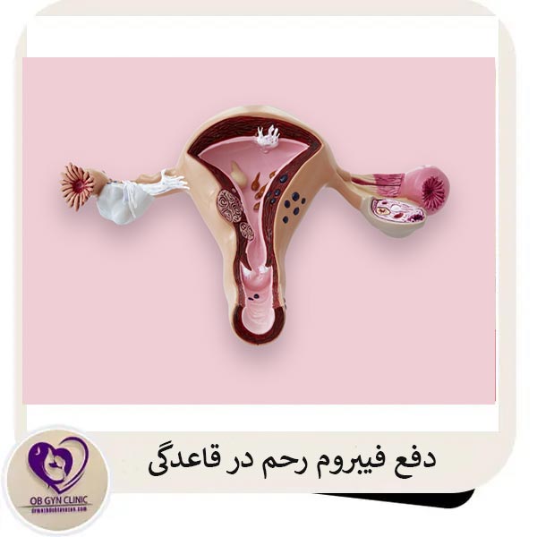 دفع فیبرومرحم در قاعدگی _ دکتر مژده تواضع