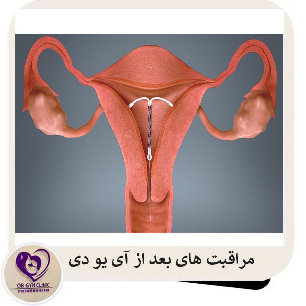 مراقبت های بعد از آی یو دی _ دکتر مژده تواضع