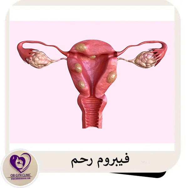 فیبروم رحم - دکتر مژده تواضع