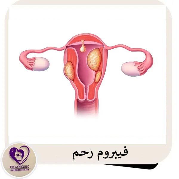 فیبروم رحم - دکتر مژده تواضع