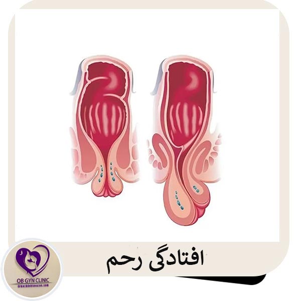 افتادگی رحم - دکتر مژده تواضع