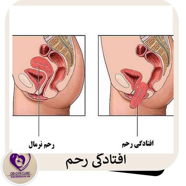 افتادگی رحم - دکتر مژده تواضع
